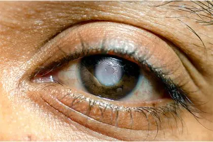 Glaucoma banner new
